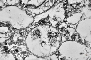 M,50y. | Pneumocystis carinii - lung